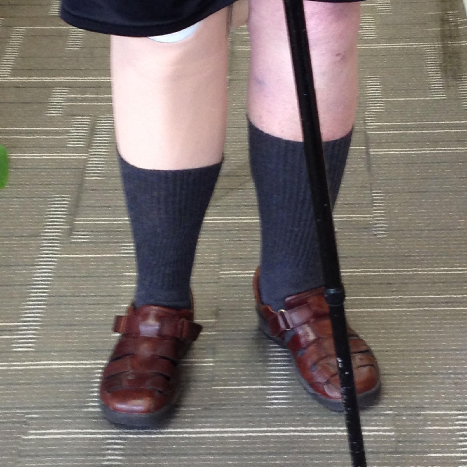 Patient wearing his transtibial prosthesis with cosmetic finish and silicone cover