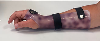 Wrist Hand Orthoses (WHO) example