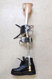 Knee-Ankle-Foot Orthoses (KAFO) example