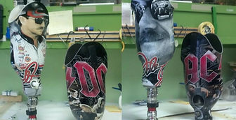 Trans-tibial Prosthesis (below knee) example