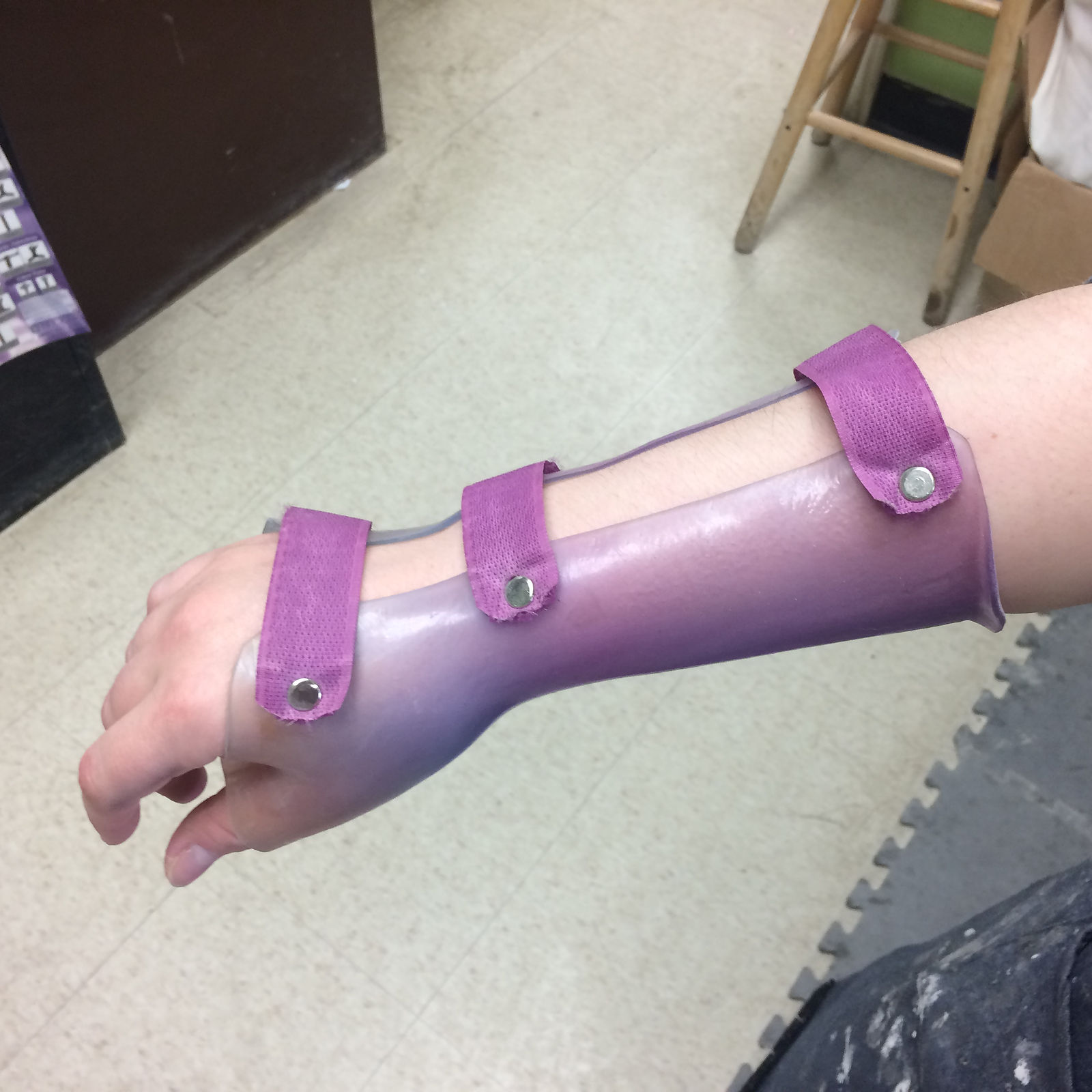 A wrist-hand orthosis (WHO)